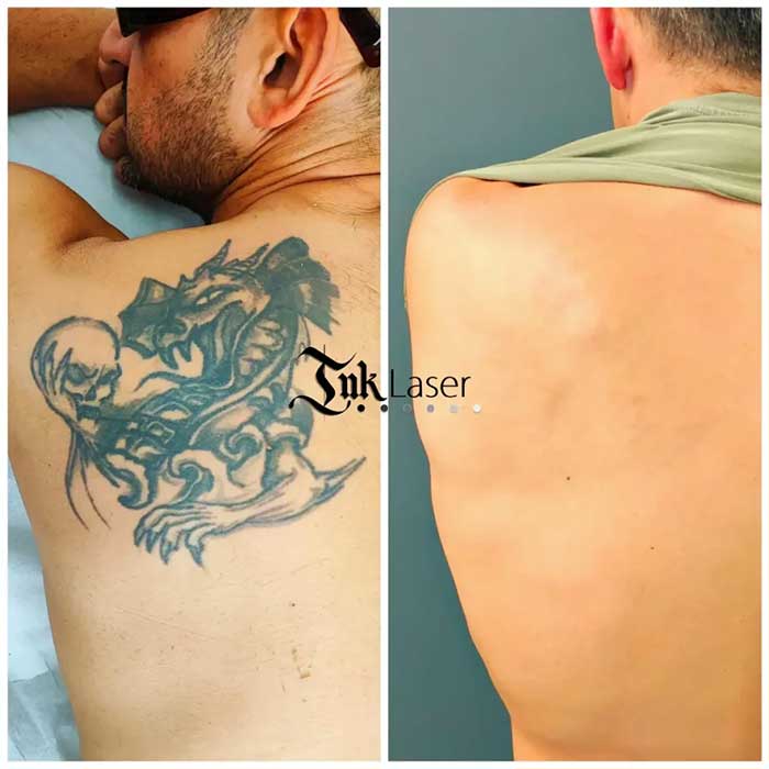 Eliminar tatuaje antes y después
