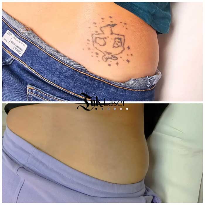 Eliminar tatuaje antes y después